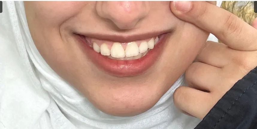 After orthodontic treatment
