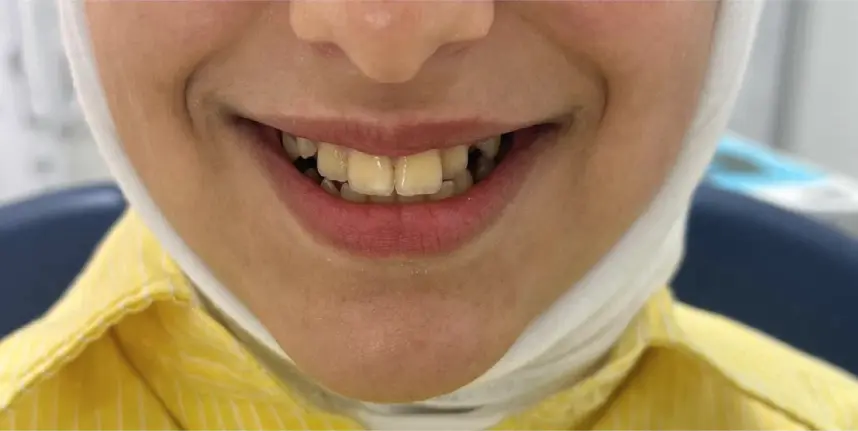 Before orthodontic treatment
